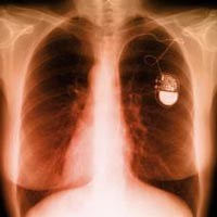 Presto i pacemaker potranno essere alimentati con le vibrazioni stesse del battito cardiaco